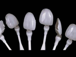 mauvezin carillas dentales
