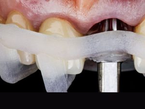 mauvezin cirujía guiada