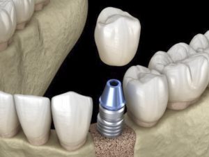 mauvezin implantes