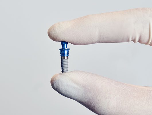 mauvezín implantología